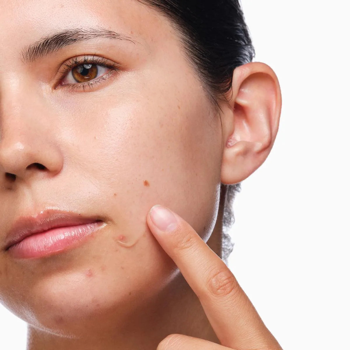 The Ordinary - The Acne Set - GOLDFARMACI