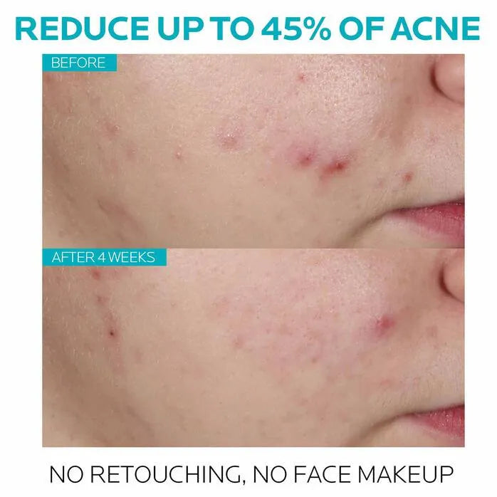 Before and after 4 weeks photo showing reduced acne on cheek, La Roche-Posay Effaclar, Goldfarmaci.